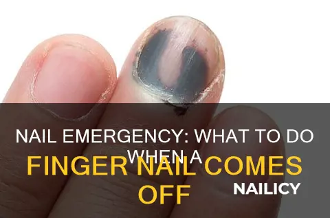 what to do if a finger nail comes off