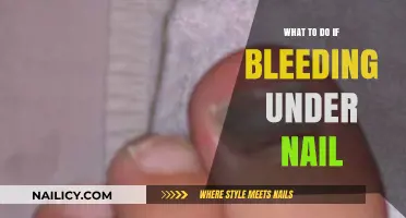 Bleeding Under Nail? Quick Relief and Treatment Tips