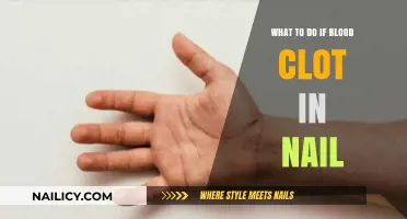 Blood Clot Under Nail: Quick Relief and Treatment Steps