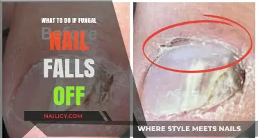 Fungal Nail Falls Off? Here’s What to Do Next