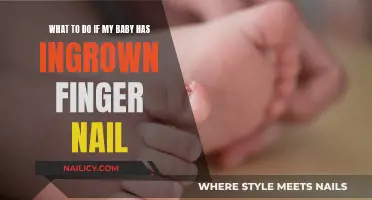 Ingrown Toenail: Tips for Soothing Your Baby's Discomfort