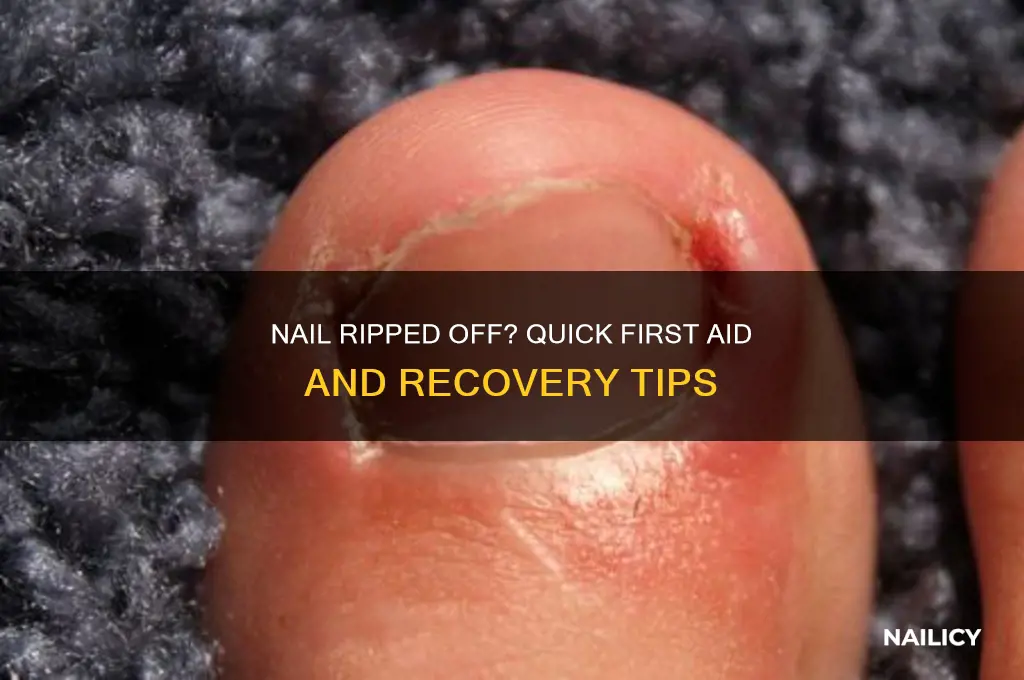 what to do if my nail rips off