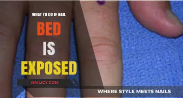 Exposed Nail Bed: Quick First Aid and Healing Tips