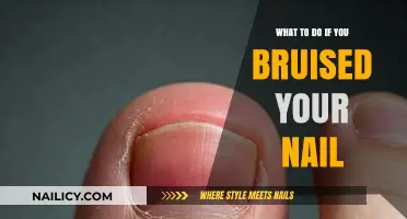 Healing Bruised Nails: Quick Tips for Pain Relief and Recovery
