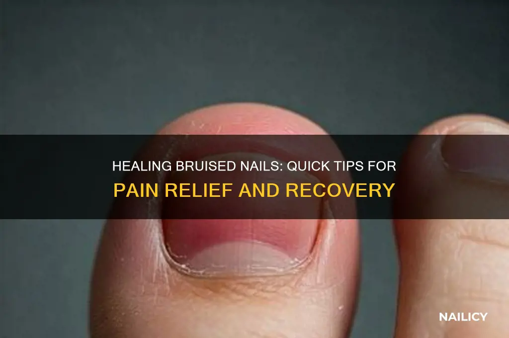 what to do if you bruised your nail