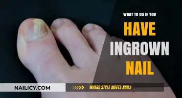 Effective Remedies and Prevention Tips for Painful Ingrown Toenails