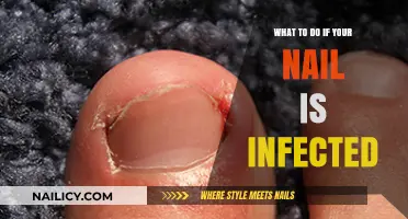 How to Treat and Prevent Infected Nails: A Comprehensive Guide
