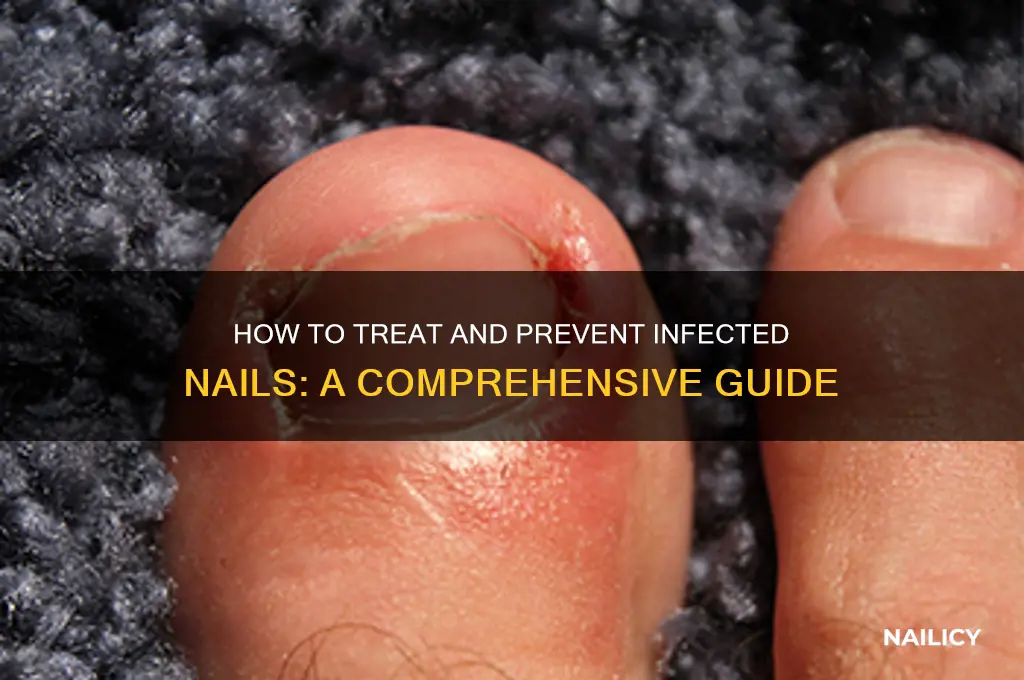 what to do if your nail is infected