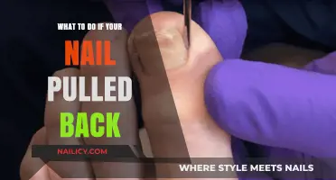 Nail Pulled Back? Quick Steps to Heal and Prevent Infection