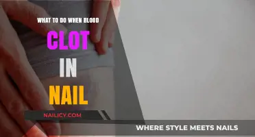 Blood Clot Under Nail: Quick Remedies and When to Seek Help