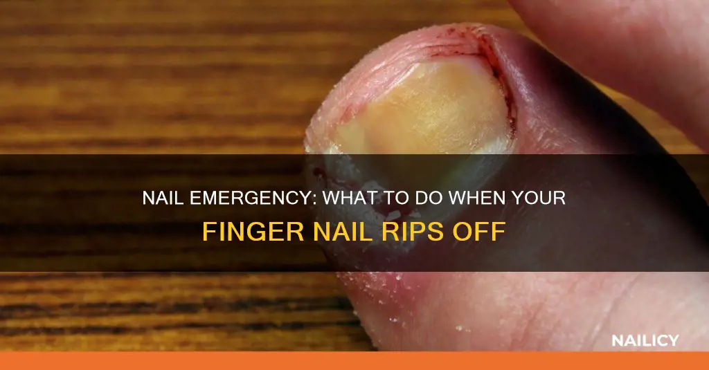 what to do when finger nail rips off