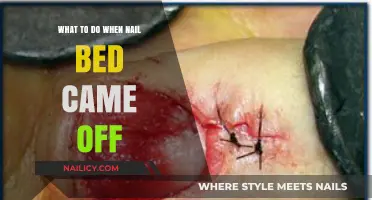 Nail Bed Injury: Quick Steps to Heal and Prevent Infection