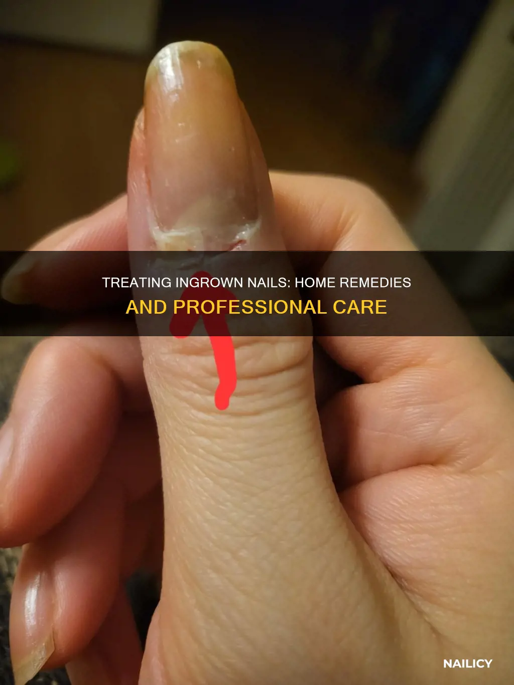 what to do when nail grows into skin