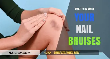 Healing Nail Bruises: Quick Remedies and Prevention Tips for Recovery