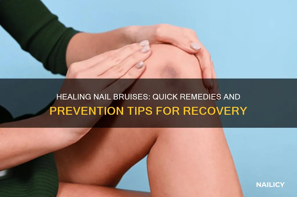 what to do when your nail bruises