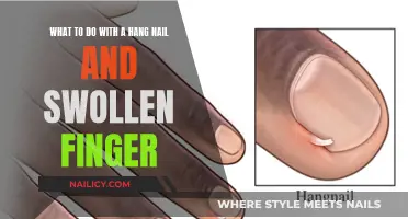 Hangnail Relief: Quick Tips for Swollen Fingers