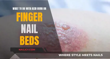 Treating Acid Burns on Fingernail Beds: Quick Home Remedies