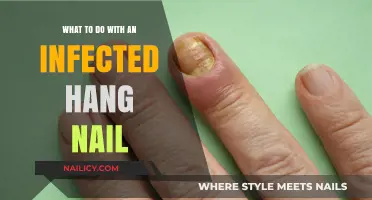 Treating an Infected Hangnail: Quick Remedies and Prevention Tips