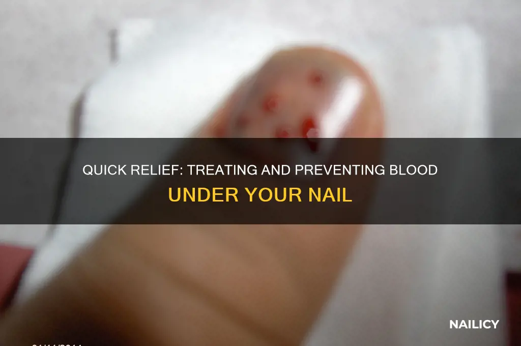 what to do with blood under nail