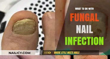 Effective Treatments and Tips for Managing Fungal Nail Infections