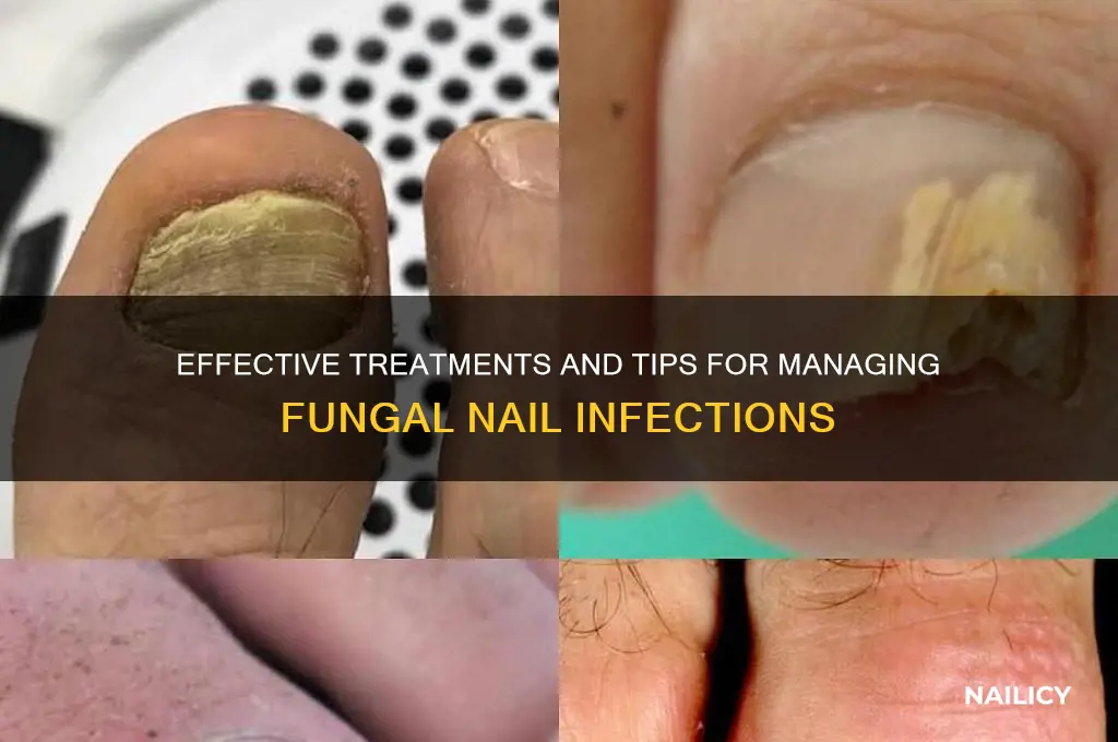 what to do with fungal nail infection