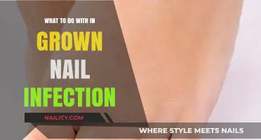 Effective Remedies for Treating Painful Ingrown Nail Infections at Home