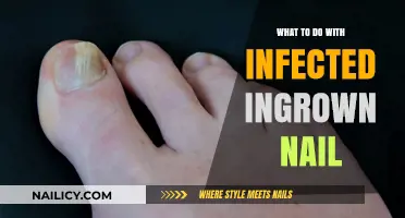 Effective Remedies for Treating Painful, Infected Ingrown Toenails at Home