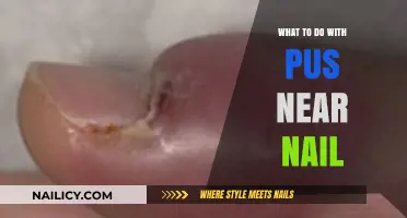 Pus Near Nail: Effective Remedies and When to Seek Help