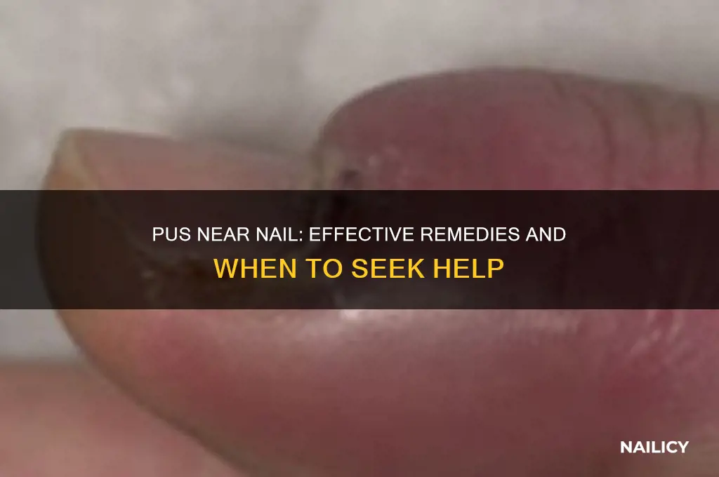 what to do with pus near nail
