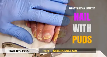 Treating Infected Nails with Puds: Effective Remedies and Care Tips