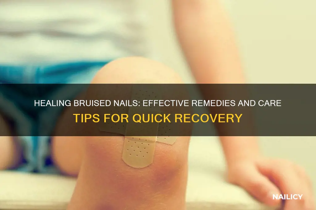what to put on a bruised nail