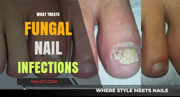 Effective Treatments for Fungal Nail Infections: Remedies and Solutions