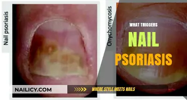 Uncovering the Hidden Causes Behind Nail Psoriasis Flare-Ups