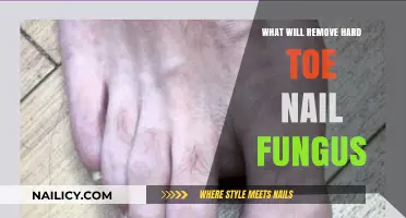 Effective Treatments to Remove Stubborn Toenail Fungus