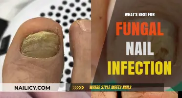 Effective Treatments for Fungal Nail Infections: Top Solutions Revealed