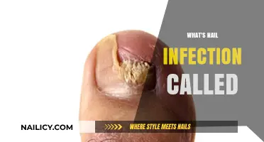 Understanding Nail Infections: What's the Condition Called and How to Treat It
