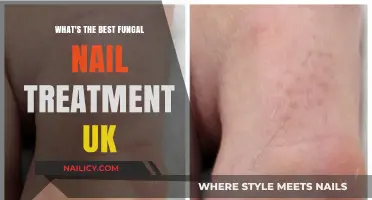 Effective Fungal Nail Treatment Options in the UK: A Comprehensive Guide