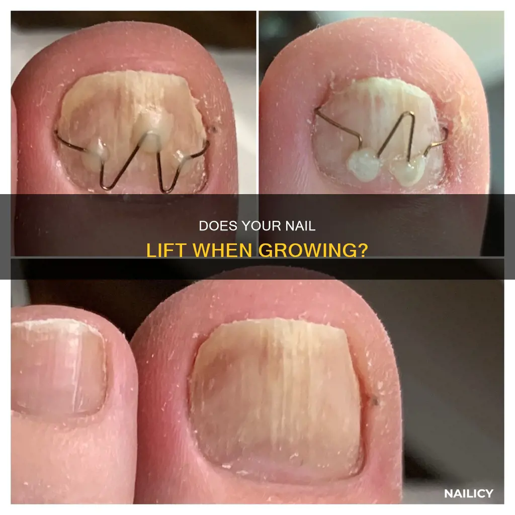 when a nail is growing does it lift