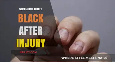 Black Nail After Injury: Causes, Concerns, and Treatment Options