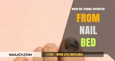 Toenail Separation: Causes, Symptoms, and Treatment for Big Toenail Detachment