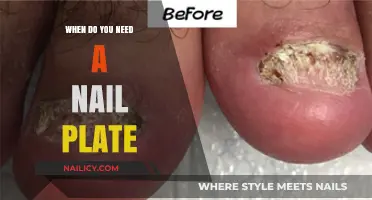 When to Consider a Nail Plate for Stronger, Healthier Nails