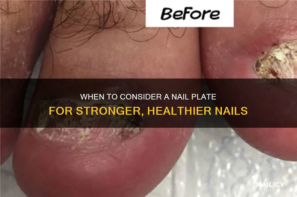 when do you need a nail plate