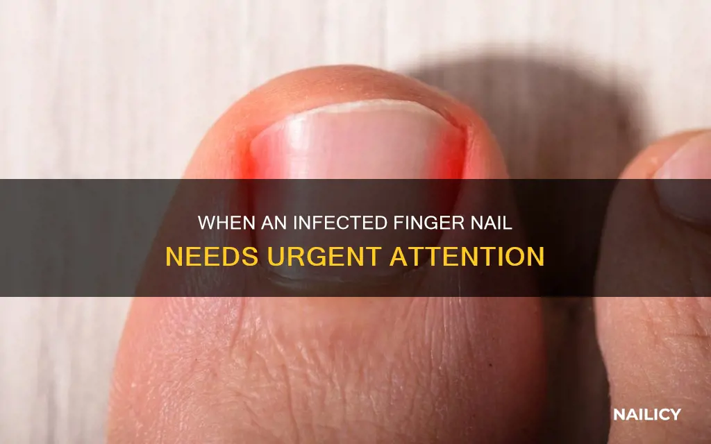 when is an infected finger nail serious