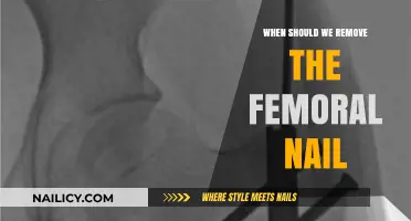 The Right Time to Remove Femoral Nails