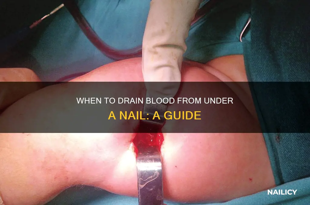 when should you drain blood from under nail