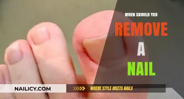 Removing a Nail: When is the Right Time?