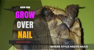 Skin Over Nails: What to Do?