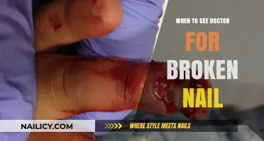 When to Seek Medical Help for a Broken Nail: A Guide