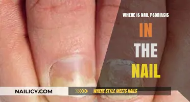 Nail Psoriasis Locations: Identifying Affected Areas on Fingernails and Toenails