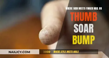 Soar Thumb: Skin Meets Nail, What's That Bump?
